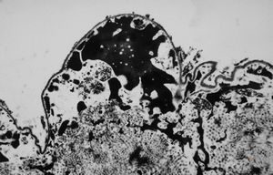 M, 63y. | cyst of choroid plexus - dystrophic calcification